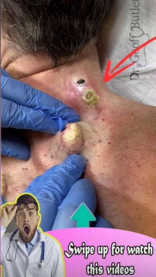 Medical Case: Dermatologist Removes Massive, Long-Standing Blackhead from Patient
