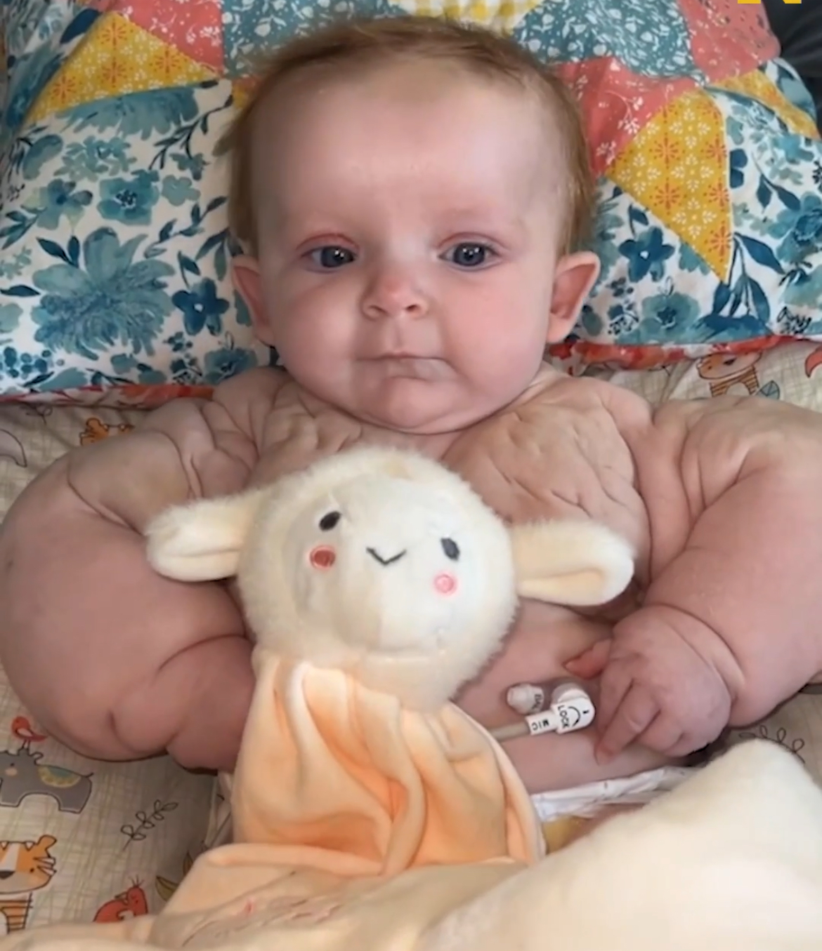 This is the girl’s current appearance following treatment. She was born with unusually huge hands and appeared to be a bodybuilder.