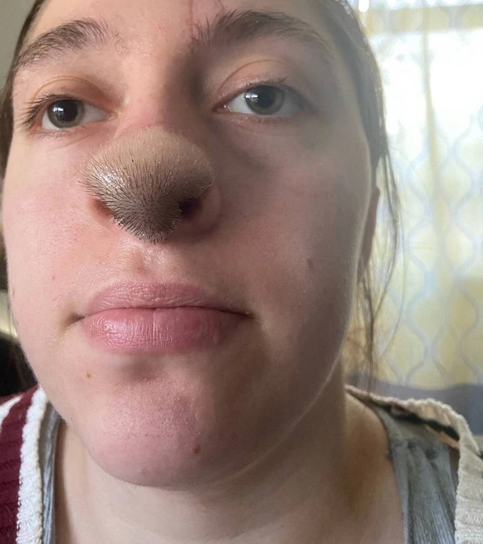 Dog Bite Leads To Hair Growing On Woman’s Nose: Photo Reveals Shocking Aftermath!