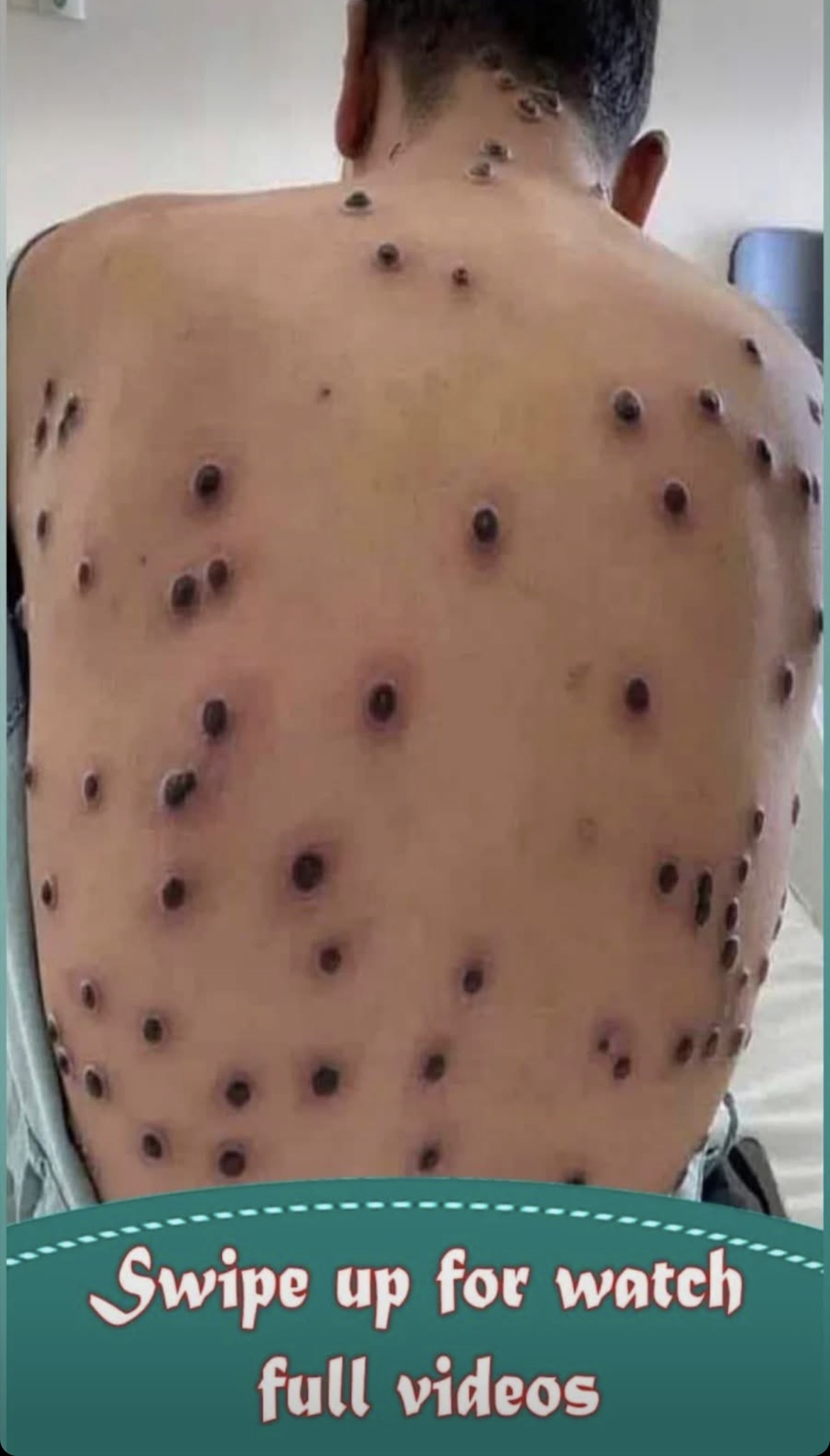 Their acne is severe